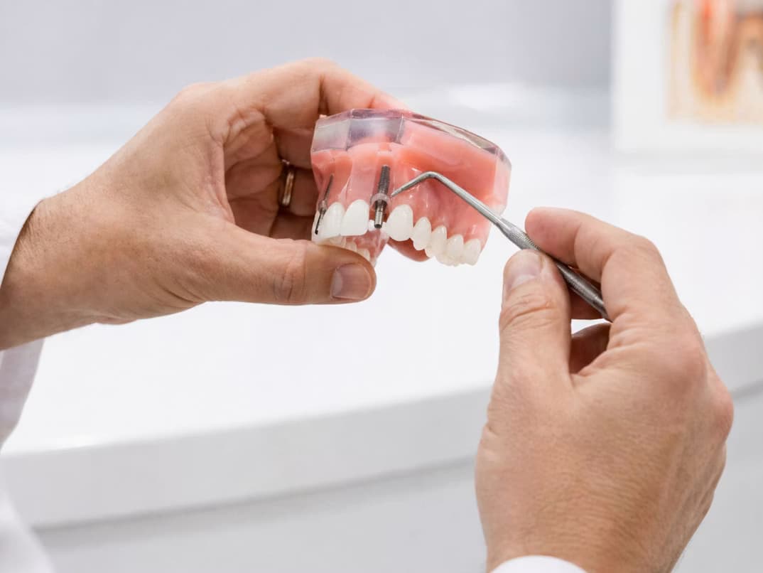 Implantes dentales en Caballito, Ciudad de Buenos Aires
